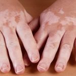 skin toxicity